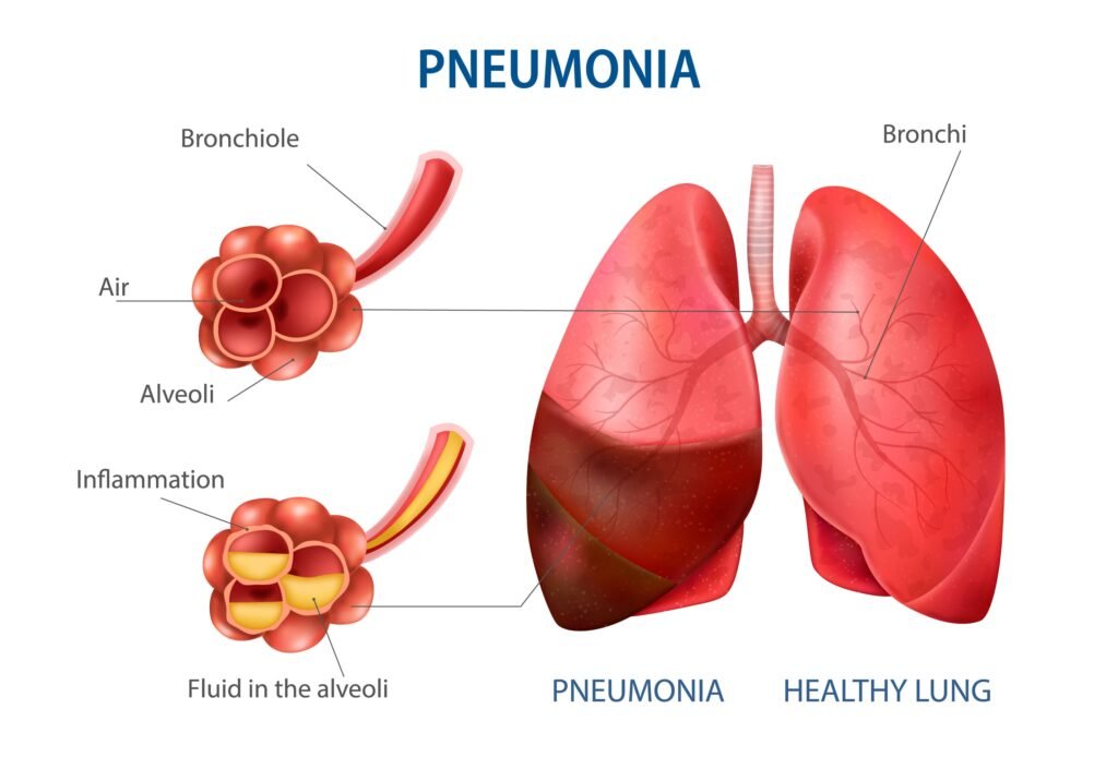 pneumonia treatment pneumonia symptoms