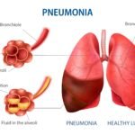 pneumonia treatment pneumonia symptoms